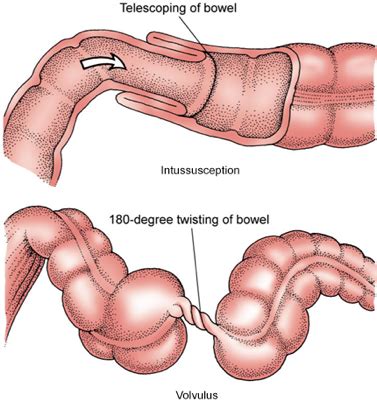 Gi Bowel Obstruction Peritonitis Diverticulitis Ibs Hernia