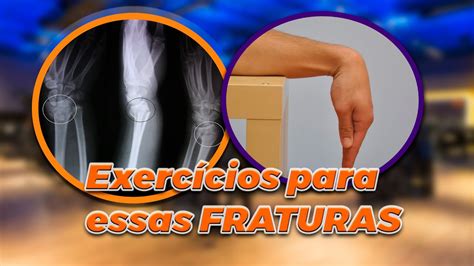 Exercícios para recuperação de fraturas de escafóide e colles guia