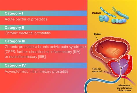 Prostatitis An Inflammatory Story