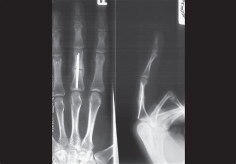 Anteroposterior And Lateral X Ray Views Show Radiological Evidence Of