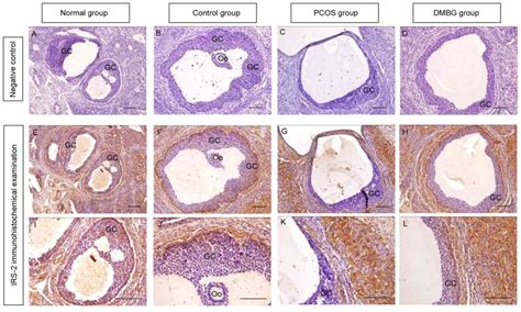 Polycystic Ovary Histology