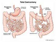 Total Gastrectomy Medical Illustration Medivisuals