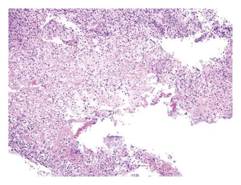 Pathology Findings Of Biopsy Specimens Hematoxylin Eosin Staining