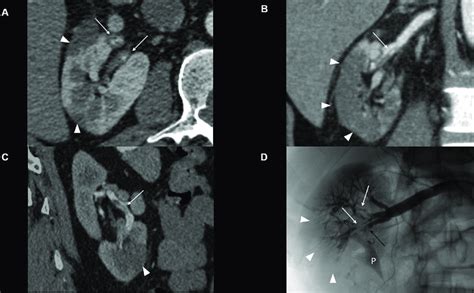 Ct Angiogram Images Demonstrating Bilateral Renal Artery Lobar Branch Download Scientific