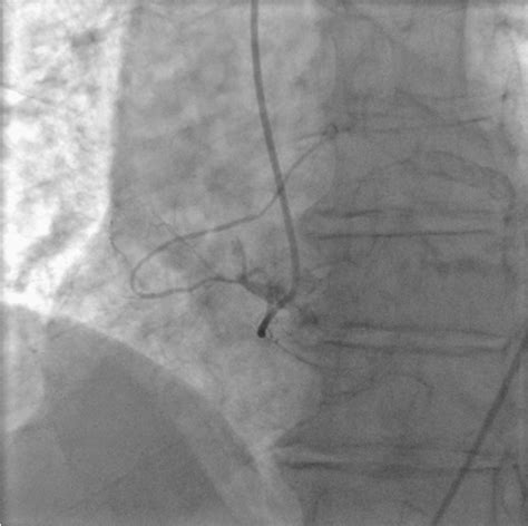 Figure 1 From A Rare Case Of Isolated Right Ventricular Infarction