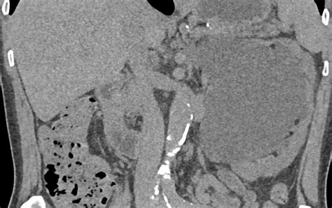 Large Parapelvic Cyst Left Kidney Kidney Case Studies Ctisus Ct