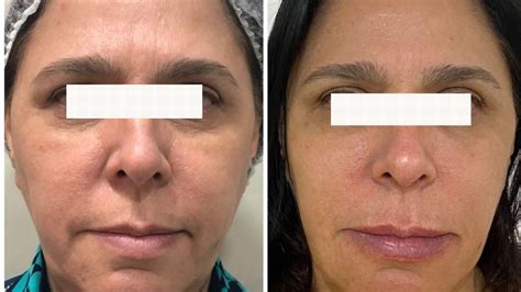 Botox No Rosto Antes E Depois Conheça Os Benefícios