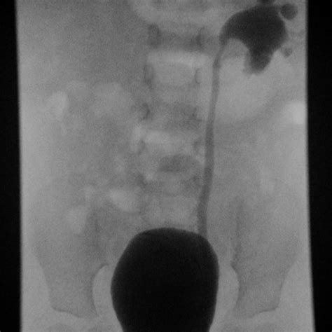 Voiding Cystourethrogram Demonstrating Grade Iii Vesicoureteral Reflux