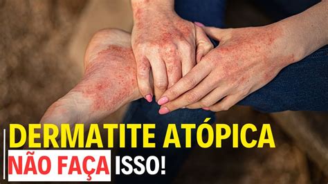 O QUE É DERMATITE ATÓPICA ENTENDA AGORA YouTube