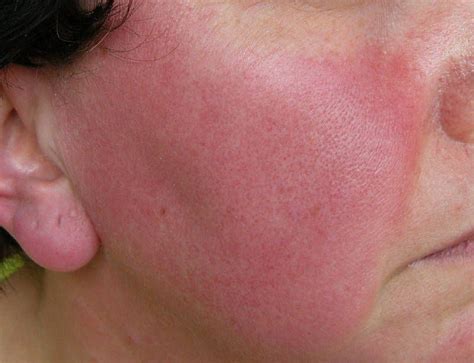 Rosacea Dermatology Sydney Rosacea Dermatology Dermatology Clinic