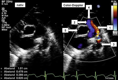 S2k Leitlinie Persistierender Ductus Arteriosus Im Kindes Und