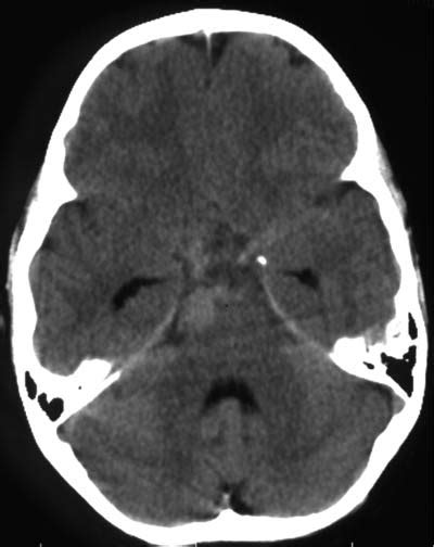 22 Giant Anterior Inferior Cerebellar Artery Aneurysm in a 6-Year-Old ...