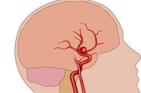 5 Hal Penyebab Aneurisma Salah Satu Penyakit Yang Menghantui Otak Kita