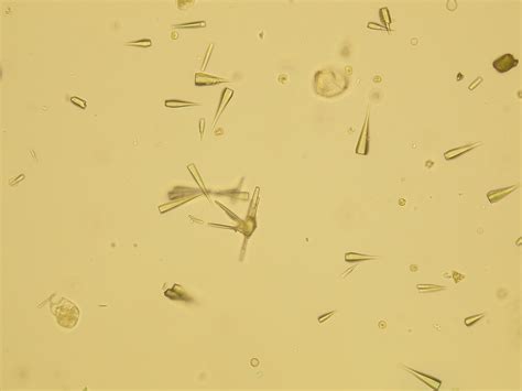 Uric Acid Crystals In Urine Under Microscope Micropedia