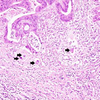 Representative Histopathological Image Of Tumor Budding Isolated