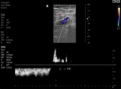 Reflux Flow In Lower Extremity Venous On Doppler Ultrasonography