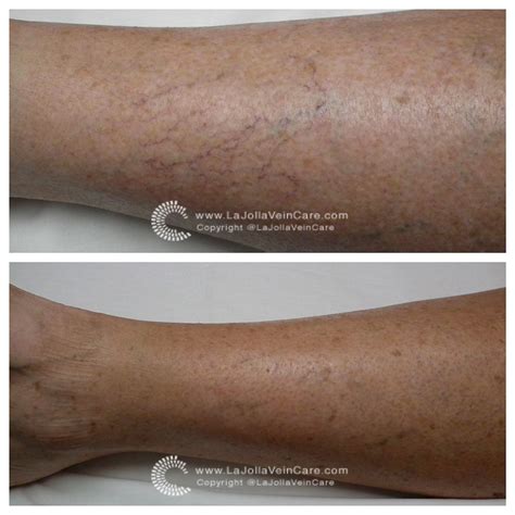 Spider Veins Before and After Patient Transformation