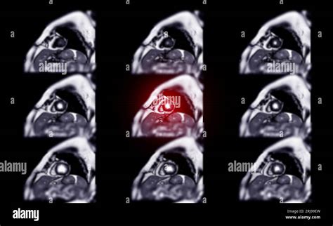 Mri Heart Or Cardiac Mri Magnetic Resonance Imaging Of Heart For