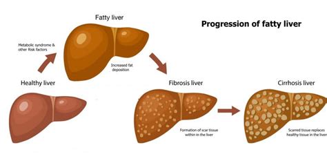 Understand all the Complications & Causes of Fatty Liver | Longevity