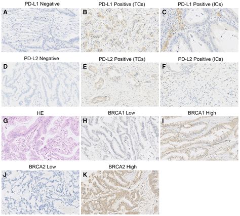 PDL1 And PDL2 Expression In Pancreatic Ductal Adenocarcinoma And