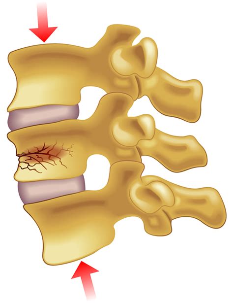 Vertebral Compression Fracture Surgery