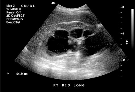 Urinary tract obstruction - Clinical Tree