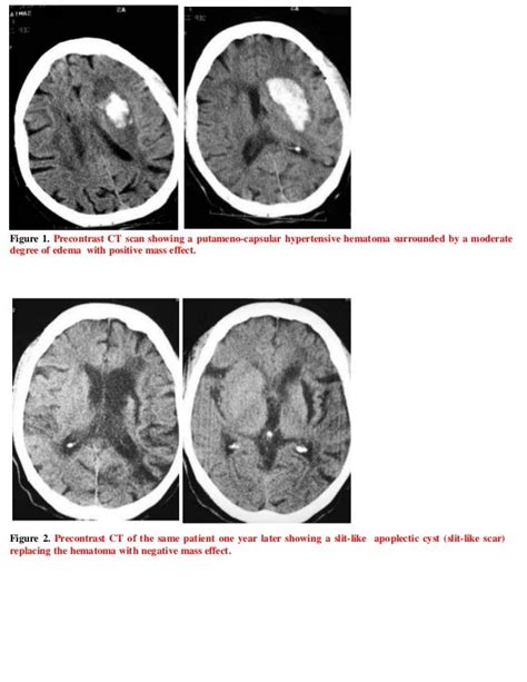 Short Case Hypertensive Cerebral Hemorrhage