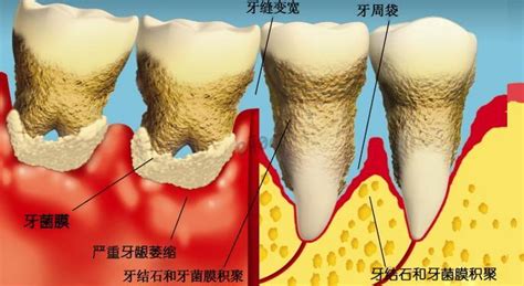 牙龈炎和牙周炎的治疗费用 爱康健齿科