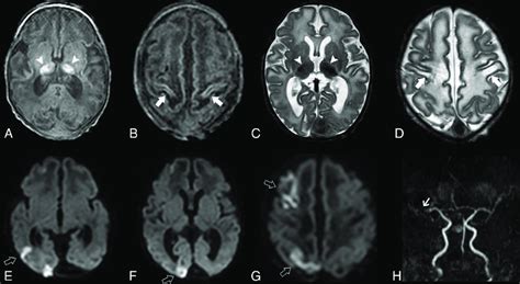 Brain MR Imaging Of Patient 2 Performed On Day 1 Axial T1 Weighted