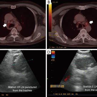 PET CT And Endobronchial Ultrasound Guided Images Of Enlarged Lymph