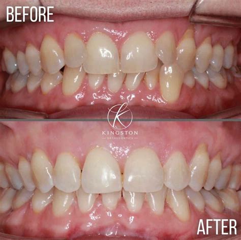 Adult Braces London - Affordable Cost | Kingston Orthodontics