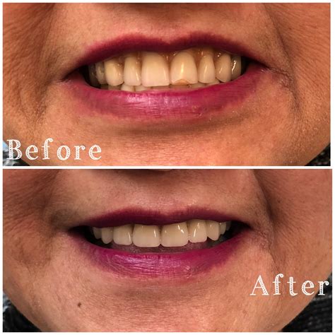 Before & After | Prestige Denture Clinic - Vancouver Washington