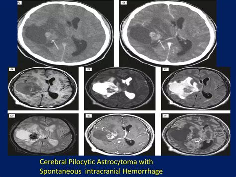 Presentation2pptx Pediatric Brain Tumour Ppt