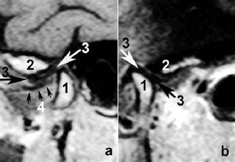 Mri Showing Left Tmj With Disc Displacement A Closed Mouth With