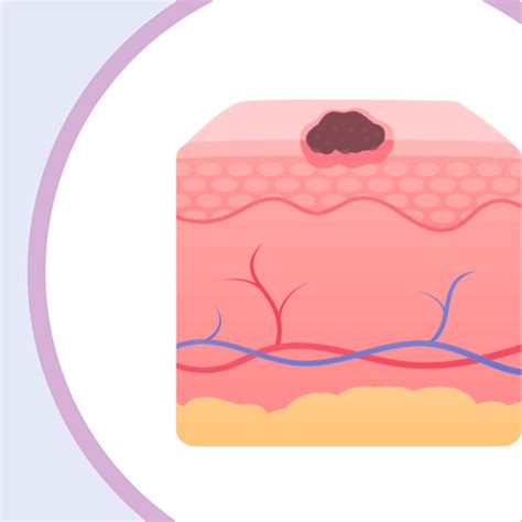 Melanoma Stage 0