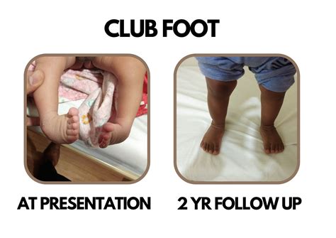 Congenital Clubfoot Surgery