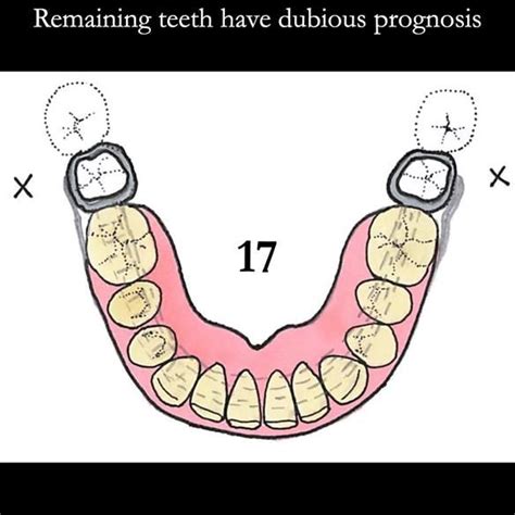 Universal Scandinavian partial denture designs | Finlay Sutton - Denture Education