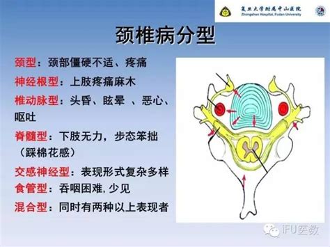 复旦大学附属中山医院 林红医生 颈椎病基本知识医数