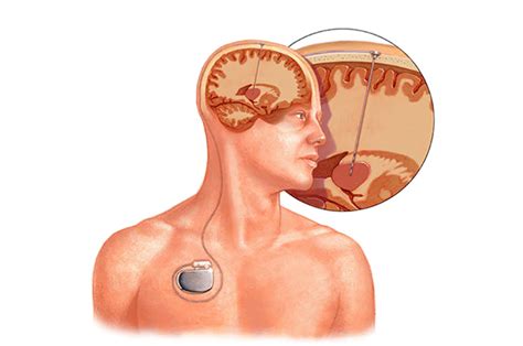 Estimulaci N Cerebral Profunda Dr Antonio Huete Allut Neurocirujano