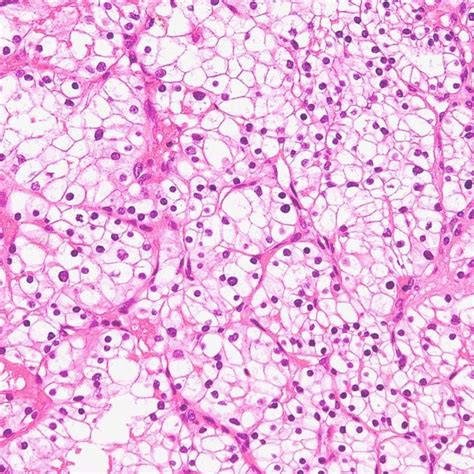 Figure1 Gastric Signet Ring Cell Carcinoma Admixed With A