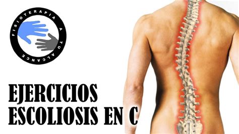 Fortalece Tu Abdomen Con Escoliosis Ejercicios Efectivos