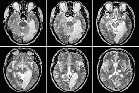 T Axial Brain Mr Images Show An Infarct Involving The Left Lingual