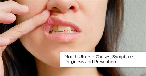 Mouth Ulcers Causes Symptoms Diagnosis And Prevention Apollo