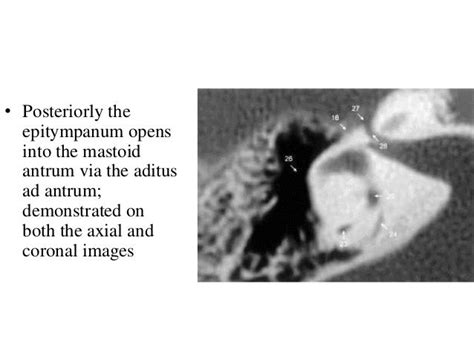 Temporal Bone Radiology