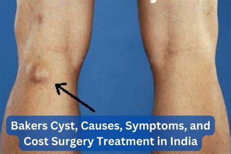 Bakers-Cyst-Causes-Symptoms-and-Cost-Surgery-Treatment-in-India