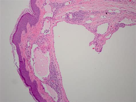 Lymphangioma Histology