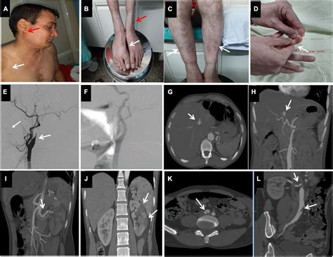 Vascular Ehlers Danlos Syndrome