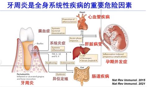 Chc 2023：口腔菌群与心血管疾病 Medscicn