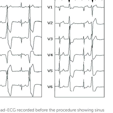 Activation Mapping Of Pvcs A Intracardiac Ecg Left Panel And