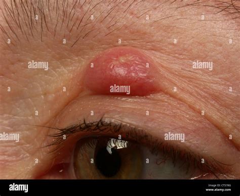 Blepharon Stockfotos Und Bilder Kaufen Alamy